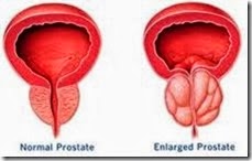 inflamed prostate
