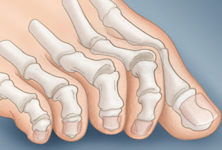 عندما تصرخ أقدامنا الشتاء!!!! webmd_rf_photo_of_claw_toe.jpg