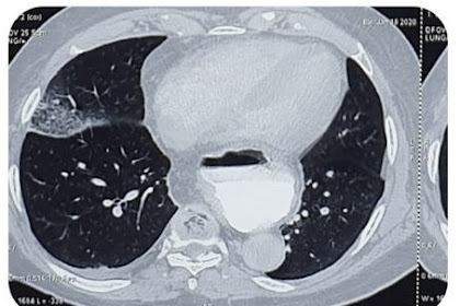 hiatal hernia pediatric radiology