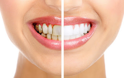  Tẩy trắng răng có lợi ích gì?