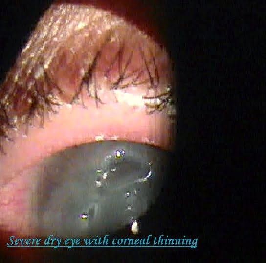 Penetrating Eye Injury. Penetrating Eye Injury,