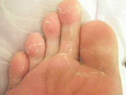 許瑞云醫師 黴菌感染 體癬 香港腳或灰指甲怎麼辦呢