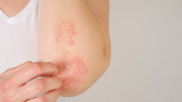 10 Widespread Skin Diseases with Photographs & Cure | SkinMentor