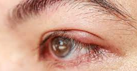 stye, stye eye, stye treatment, eye stye, how to get rid of a stye, stye on eyelid, what is a stye, how to treat a stye, stye in eye, what causes a stye, chalazion vs stye, beginning stages of eye stye, stye in the eye, how to get rid of a stye overnight, how to get rid of stye, eye stye treatment, stye on eye, stye symptoms, stye eye drops, internal stye, stye medicine, how do you get a stye, stye inside eyelid, stye eyelid, stye pop, how long does a stye last, what does a stye look like, stye causes, is a stye contagious, stye eye treatment, stye treatments, how to get rid of stye on eyelid fast, stye under eyelid, what is a stye in your eye, stye vs chalazion, what causes a stye in your eye, stye ointment, can you pop a stye, what to do for a stye, eye drops for stye, stye on the eye, stye medication, eye stye causes, stye swollen eyelid, stye self-care, stye on upper eyelid, whats a stye, what causes stye eye, stye warm compress, how do you get rid of a stye, home remedies for stye, stye under eye, how to get rid of an eye stye, stye contagious, stye in spanish, stye in eye treatment, how long does it take a stye to go away, how to get rid of a stye in 24 hours, pink eye vs stye, stye cream, stye inside lower eyelid, stye on lower eyelid, stye on my eye, stye treatment antibiotic, how to get rid of a stye fast, stye in corner of eye, stye vs pink eye, antibiotic ointment for stye, what is an eye stye, stye eye ointment, is stye contagious, eye stye pictures, how to cure a stye, stye gone but bump still there, what is a stye in the eye, how to stop a stye from forming, blepharitis vs stye, stye eye infection, stye drops, how do you get a stye on your eye, stye inside eyelid treatment, stye on inside of eyelid, over the counter stye medication, dog stye, treatment for stye, how do you get a stye in your eye, eyelid stye, stye infection, how to get rid of stye overnight, eye stye covid, infected stye, how to heal a stye, eye stye medication, dog eyelid stye, stye pop gif, stye removal, treatment for stye in eye, stye in eyelid, how to pop a stye, stye eye contagious, hordeolum, internal hordeolum, hordeolum vs chalazion, chalazion vs hordeolum, hordeolum externum, hordeolum internum, hordeolum treatment, external hordeolum, hordeolum stye, internal hordeolum treatment, hordeolum eye, eye hordeolum, eyelid hordeolum, what is hordeolum, hordeolum icd 10, hordeolum pronunciation, stye vs hordeolum, hordeolum chalazion, hordeolum vs stye, chalazion hordeolum, internal hordeolum icd 10, hordeolum versus chalazion, chalazion versus hordeolum, hordeolum externum left upper eyelid, hordeolum internum vs externum, internal vs external hordeolum, internal hordeolum vs chalazion, difference between hordeolum and chalazion, difference between chalazion and hordeolum, hordeolum plural, chalazion vs hordeolum vs stye, stye hordeolum, chalazion and hordeolum, hordeolum and chalazion, hordeolum internum treatment, hordeolum internal, affliction also known as hordeolum crossword, hordeolum externum vs internum, hordeolum upper eyelid, stye vs hordeolum vs chalazion, stye vs chalazion vs hordeolum, hordeolum externum right upper eyelid, external vs internal hordeolum, hordeolum definition, affliction known as hordeolum, chalazion vs stye vs hordeolum, internal hordeolum treatment review of optometry, blepharitis vs hordeolum vs chalazion, affliction also known as a hordeolum, hordeolum vs chalazion treatment, internal hordeolum lower lid, hordeolum wikipedia, affliction also known as hordeolum, chalazion vs hordeolum usmle, hordeolum eye drops,