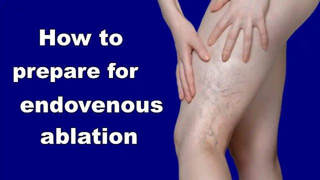 Embracing the Vein Voyage A Guide on How to Prepare for Endovenous Ablation with Varicose Vein