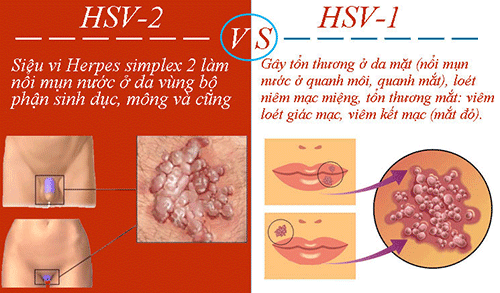 Nguyên nhân gây herpes simplex là gì?