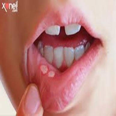 aftas-na-boca-causas-sintomas-e-tratamento