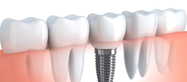 West Chester Affordable Dental Implants