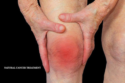 PIC OF ARTHRITIS