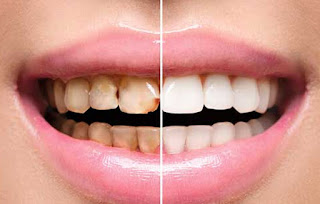 Full Mouth Dental Rehabilitation in Mulund East