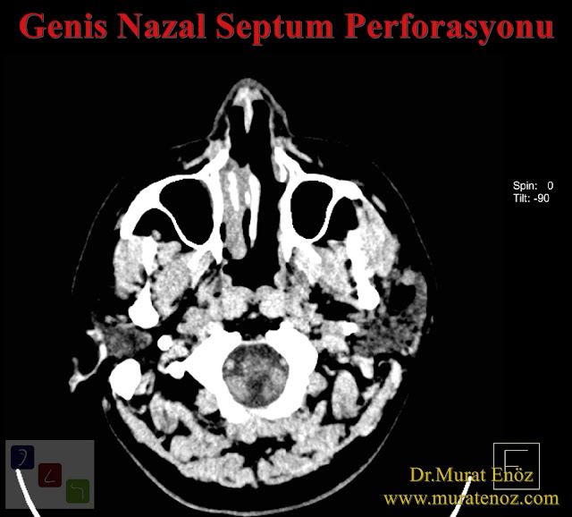 Nazal septum perforasyonu