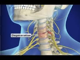 Cervical Spondylosis Spinal Nerve
