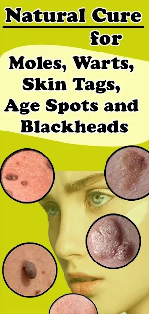 Natural Cure for Moles, Warts, Skin Tags, Age Spots and Blackheads