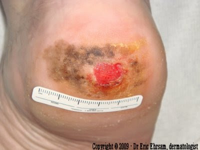 acral lentiginous melanoma