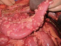 what is the treatment for mesothelioma