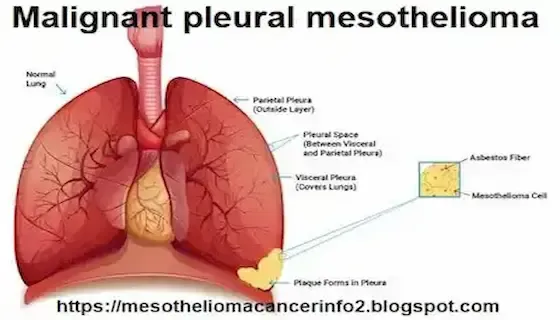 A Comprehensive Review for Malignant Pleural Mesothelioma