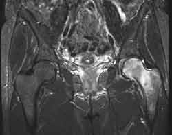 Puasa Obat Osteoporosis Bisa Melindungi Tulang