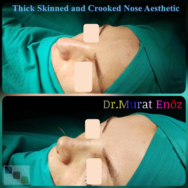 Crooked Nose Aesthetic,Female Nose Job, Rhinoplasty in Istanbul