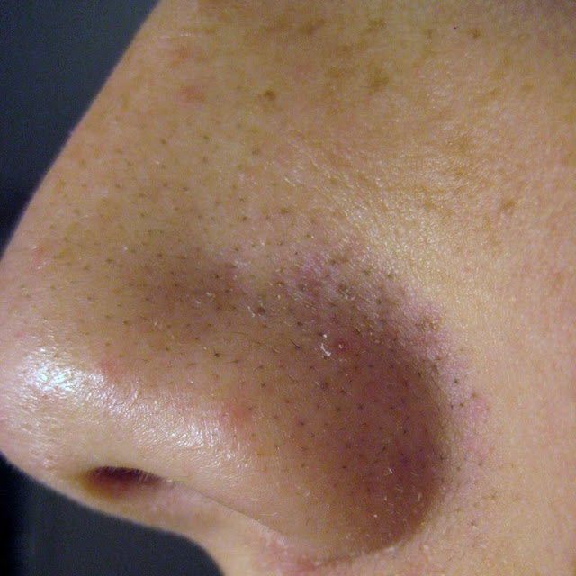 Blackheads causes and treatment