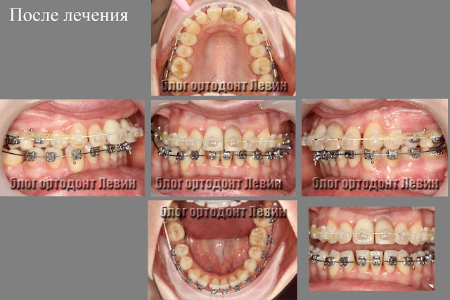 На этапе лечения, через два года лечения брекетами Damon