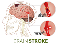 Obat Stroke Pendarahan Otak