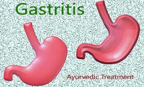 gastritis-ayurvedic-allopathic-cure