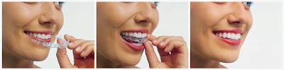 invisalign orthodontics dr doug booth