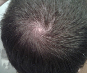 ¿Remolino o alopecia?