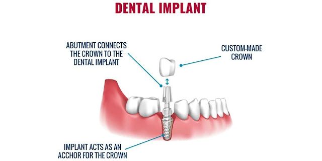dental implants clinic in gurgaon