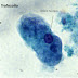 Entamoeba histolytica