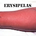 ERYSIPELAS : DEFINITION ,CLINICAL FEATURES & COMPLICATIONS