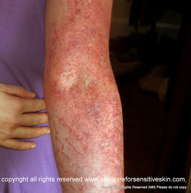 Skin Rash And Damage From Skin Allergies On My Arm