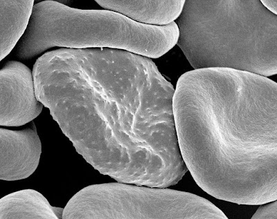 eritrosit yang terinfeksi plasmodium falsiparum falciparum malaria anopheles stephensi anopeles tertiana tropikana tropicana inflamasi sel darah merah knop kenop mikroskop elektron praktikum laboratorium kedokteran parasitologi mikrobiologi infeksi tropik