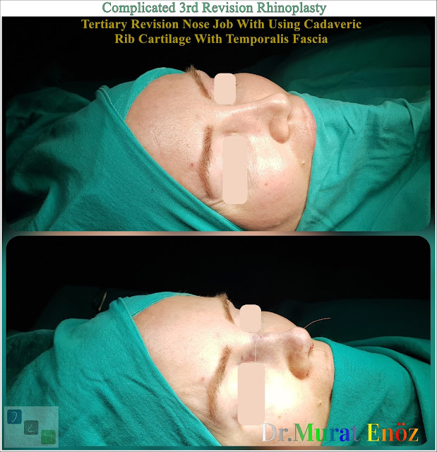 Complicated 3rd Revision Rhinoplasty - Tertiary Revision Nose Job With Using Cadaveric Rib Cartilage With Temporalis Fascia