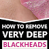 10 Ways To Get Rid Of Deep Blackheads