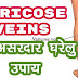 Home Remedies for Varicose Veins | वैरिकोज वेन्स के घरेलू उपाय