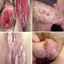 Cara untuk Menghilangkan Kutil Kelamin di Rumah- Kutil kelamin adalah penyakit seksual menular yang disebabkan oleh virus yang bernama Humanpapilloma virus (HPV) merupkan infeksi menular seksual (IMS) yang paling sering. Terdapat lebih dari 40 jenis HPV yang dapat menginfeksi daerah kelamin laki-laki dan perempuan. Jenis HPV ini juga dapat menginfeksi mulut dan tenggorokan. Kebanyakan orang yang terinfeksi dengan HPV bahkan tidak tahu mereka memilikinya. HPV tidak sama dengan herpes atau HIV (AIDS). Kesamaannya adalah semuanya dapat ditularkan saat berhubungan seks, tetapi menyebabkan gejala dan masalah kesehatan yang berbeda.Tanda Dan Gejala Yang Berkaitan Dengan HPV (Kutil Kelamin)  Kutil pada kelamin biasanya muncul sebagai benjolan kecil atau kelompok benjolan di daerah kelamin. Bentuknya bermacam-macam, bisa berukuran kecil atau besar, menonjol atau rata, atau berbentuk seperti kembang kol. Petugas kesehatan dapat mendiagnosis kutil hanya dengan melihatnya di daerah kelamin saat pemeriksaan. Kutil dapat muncul dalam beberapa minggu atau bulan setelah hubungan seksual dengan pasangan yang terinfeksi, Namun, kutil dapat juga muncul bahkan jika pasangan yang terinfeksi tidak memiliki tanda-tanda kutil pada kelamin. Jika tidak diobati, kutil pada kelamin bisa hilang, tetap tidak berubah, atau bisa juga bertambah besar ukurannya. Perlu diingat bahwa kutil pada kelamin tidak akan berubah menjadi kanker.  Kanker serviks sulit untuk dideteksi pada tahap awal, karena biasanya tidak memiliki gejala yang parah. Untuk alasan ini, penting sekali bagi perempuan melakukan skrining rutin untuk kanker serviks. Tes skrining dapat menemukan tanda awal penyakit sehingga penyakit tersebut dapat diobati secara dini, sebelum berubah menjadi kanker. Hal yang berkaitan dengan kanker HPV mungkin tidak memiliki tanda atau gejala hingga parah dan sulit diobati. Ini termasuk kanker vulva, vagina, penis, dubur, dan kepala dan leher.