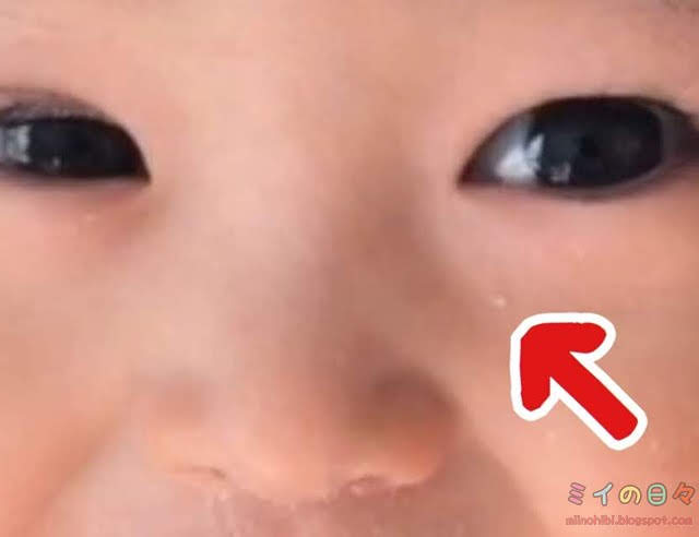 赤ちゃんの顔にできた白いポツポツの正体は稗粒腫 はいりゅうしゅ ミイの日々