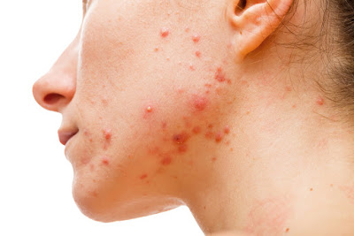 A woman with acne all over her jawline.