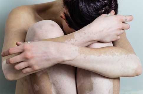 Cara Cepat Menghilangkan Vitiligo dengan Ampuh