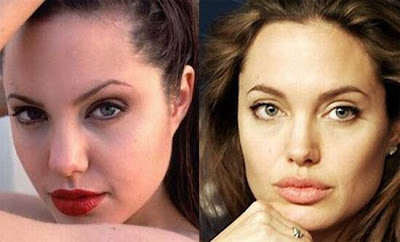 celebrity plastic surgery