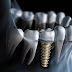 Chi phí cấy ghép răng implant bao nhiêu?