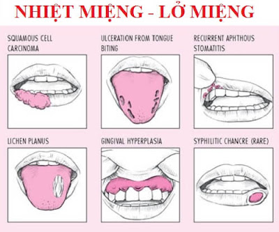 Bị nhiệt miệng nên kiêng gì?