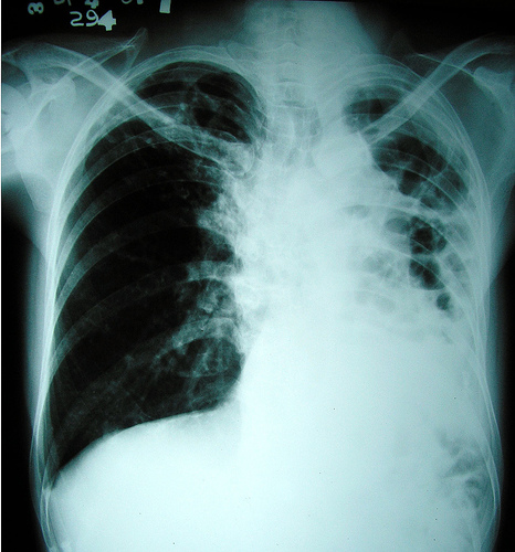 Nursing Diagnosis Ineffective Airway Clearance related to Pulmonary 