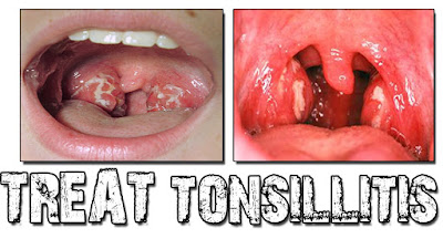 Tonsillitis and Natural Treatment