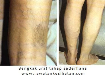 Kelemahan limpa pada tahap sederhana selalu disalahertikan sebagai Gout! oleh rawatan klasik (rawatan hospital)