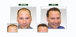 hair loss