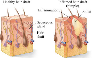 acne structure