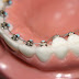 Tìm hiểu về phương pháp niềng răng móm
