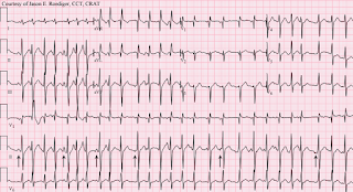 多源性心房心搏過速 Multifocal atrial tachycardia, MAT